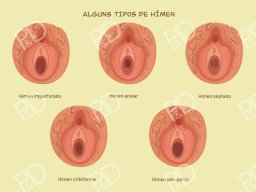 kit-album-pedagogico-pdfactor-prancha-04-alguns-tipos-de-himen-800x566